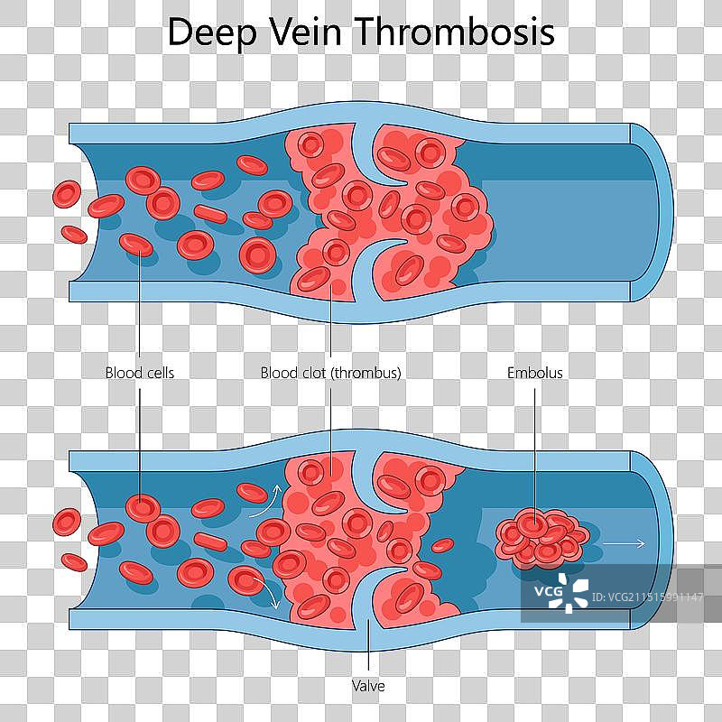深静脉血栓DVT医学图图片素材