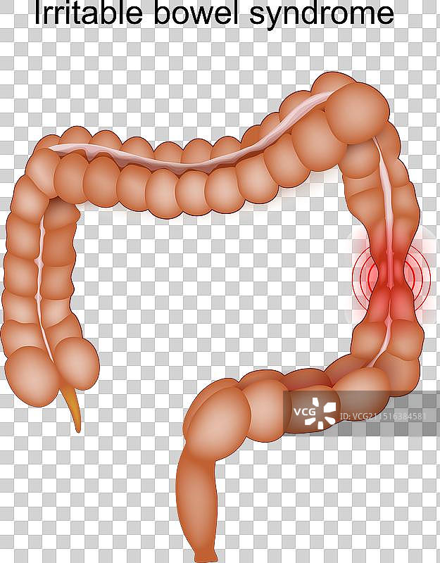 肠易激综合征症状图片素材