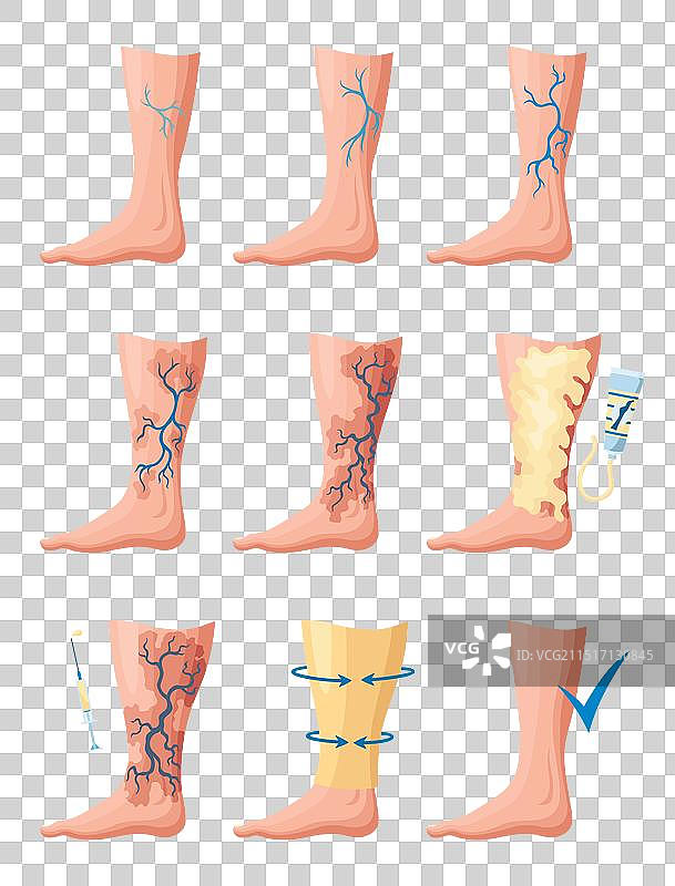 静脉曲张的发展阶段或类型图片素材