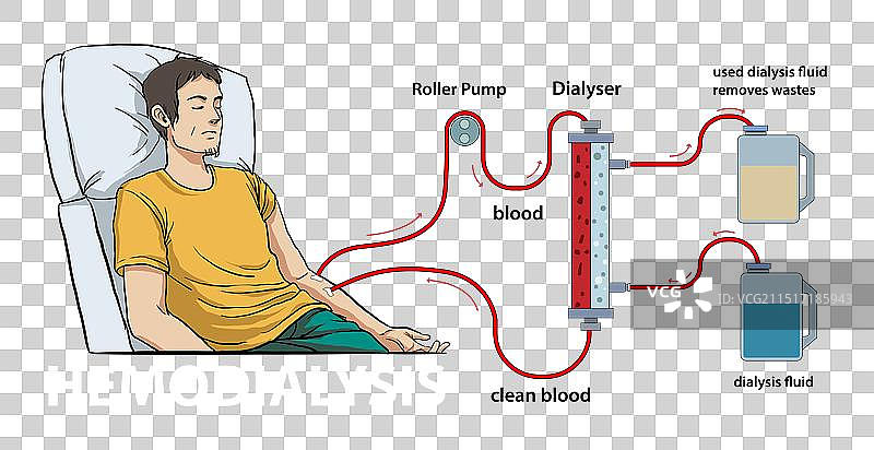 血液透析图示图片素材
