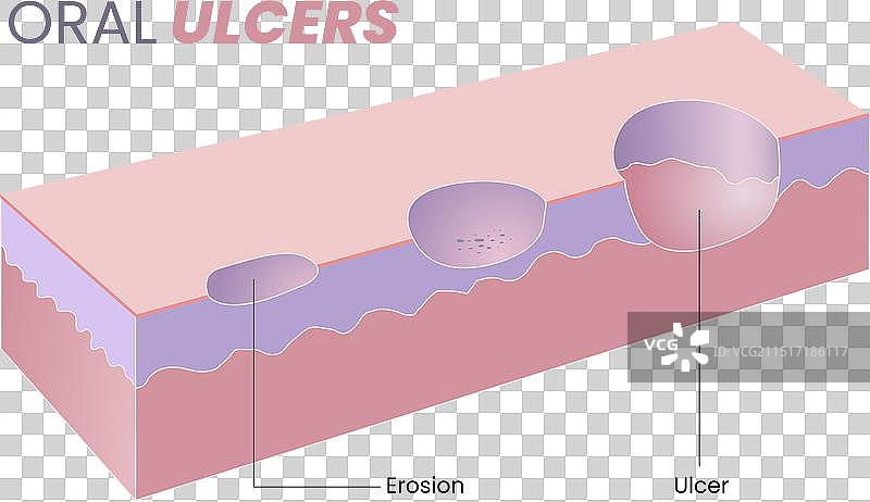 口腔溃疡图图片素材