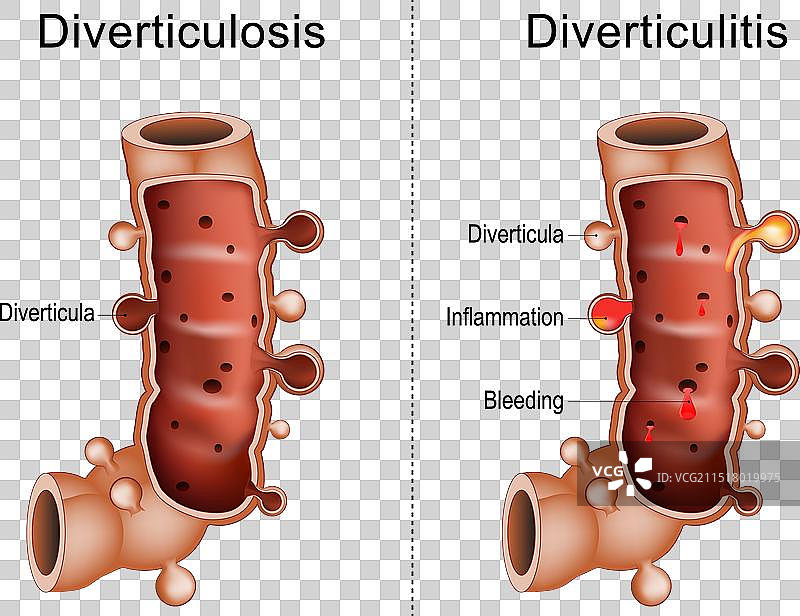 憩室炎的区别图片素材