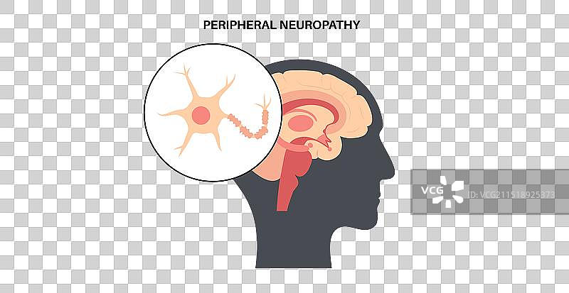 周围神经病变医学海报图片素材