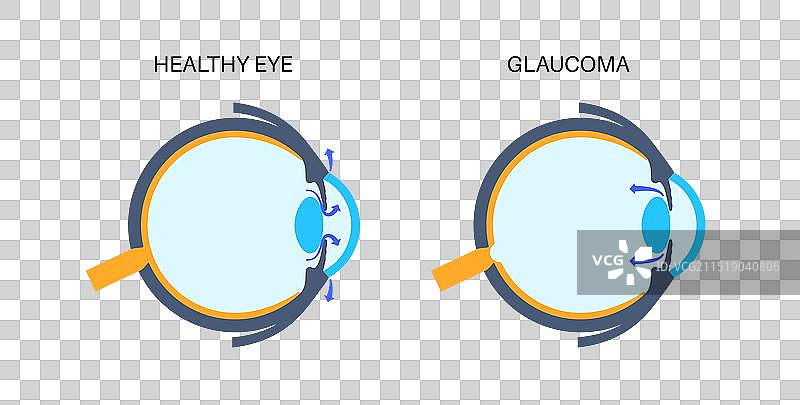 青光眼眼科疾病图片素材