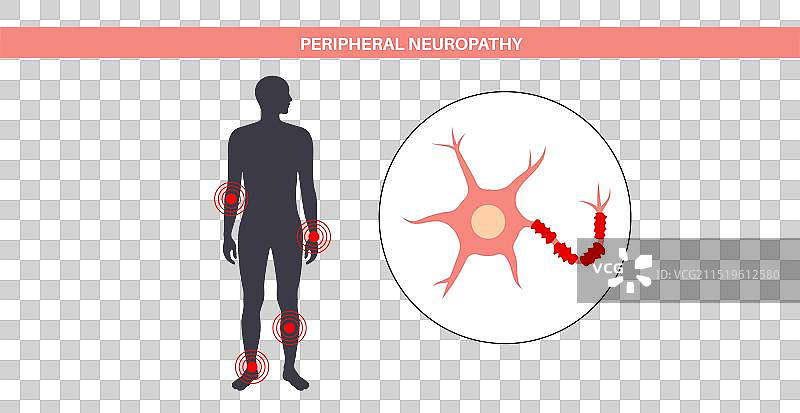 周围神经病变医学海报图片素材