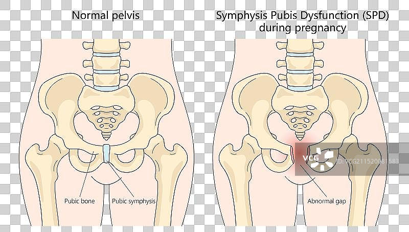 妊娠期耻骨联合功能障碍图片素材