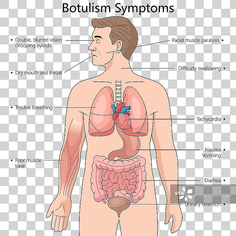 肉毒杆菌中毒症状医学图解图片素材