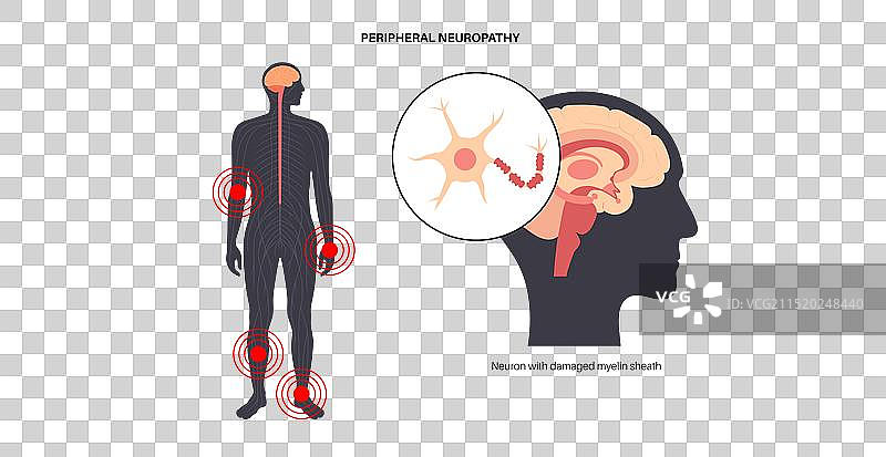 周围神经病变医学海报图片素材