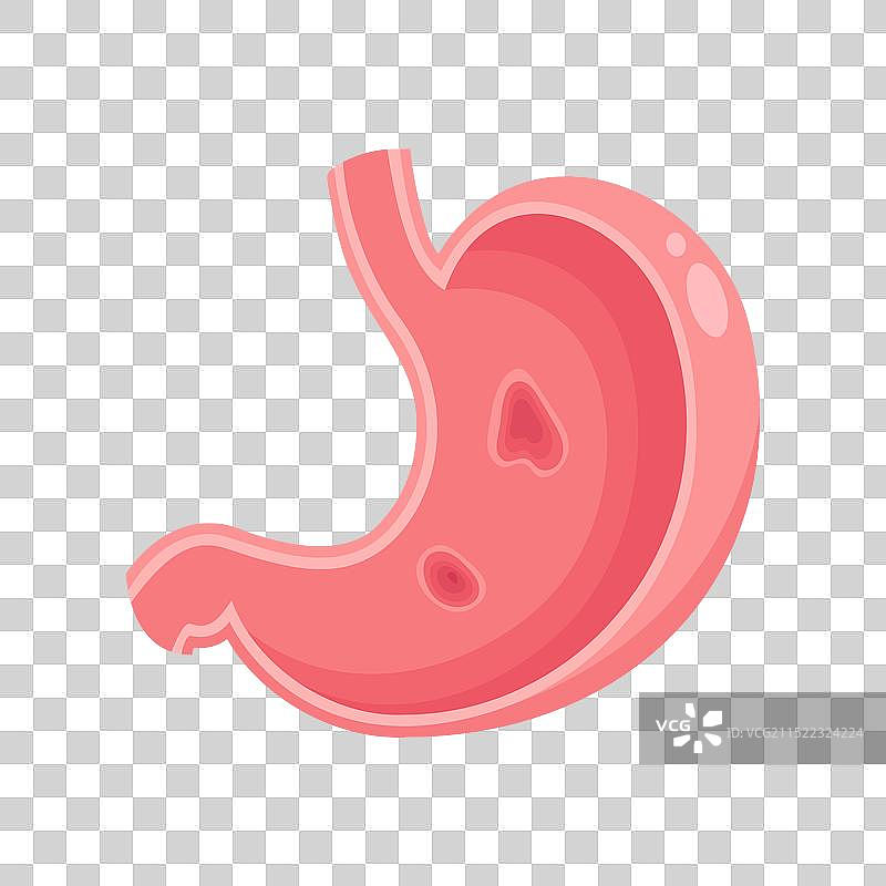 胃溃疡图片素材