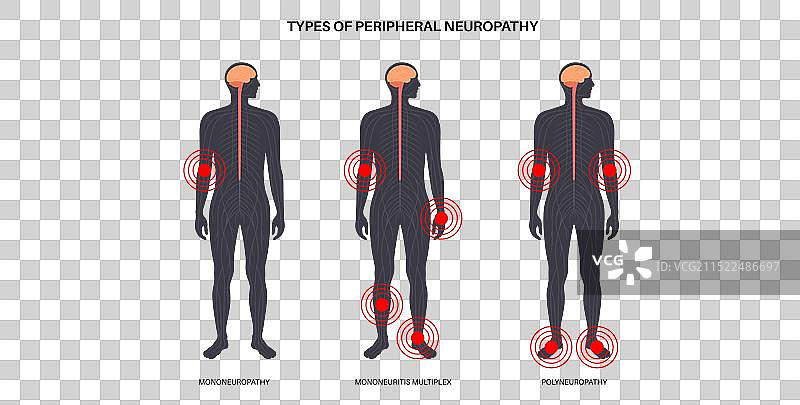 周围神经病变医学海报图片素材