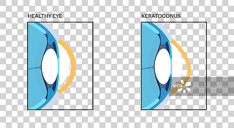 白内障眼病图片素材