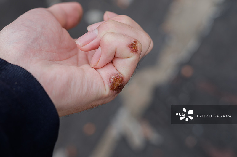 受伤的手部特写镜头图片素材