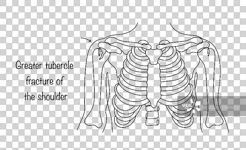肩部骨折图片素材