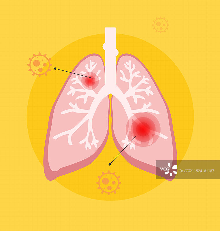 肺炎图片素材