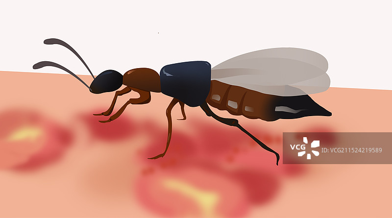 隐翅虫毒虫昆虫害虫伤害皮肤健康身体红肿发炎溃烂疾病病毒资讯卡通虫子插画图片素材