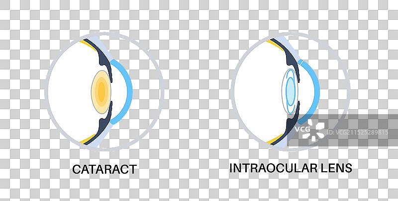 眼内晶体海报图片素材