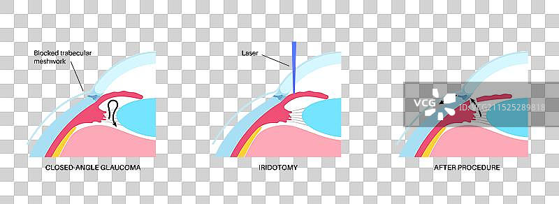 虹膜切除术医学海报图片素材