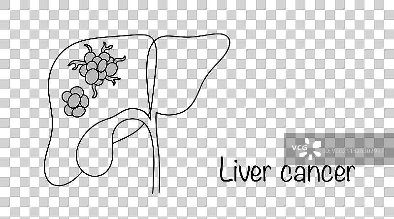 肝癌图片素材