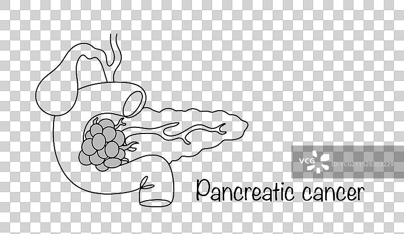 胰腺癌图片素材