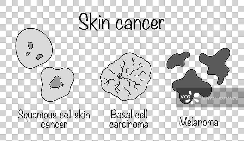 皮肤癌图片素材