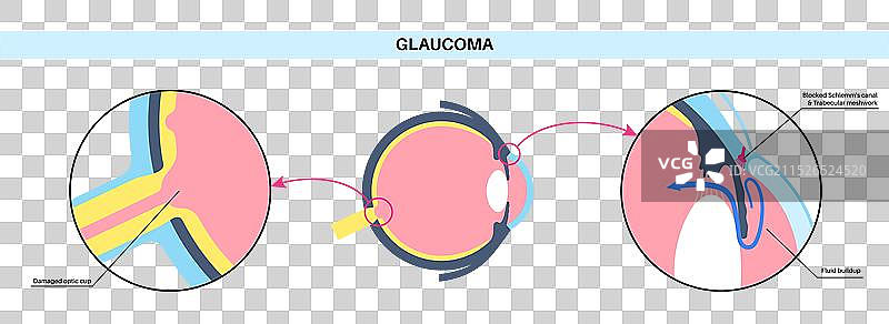 青光眼眼科疾病图片素材
