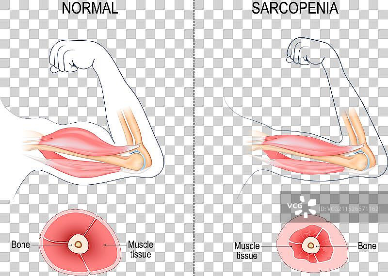 肌肉减少症肌肉萎缩图片素材