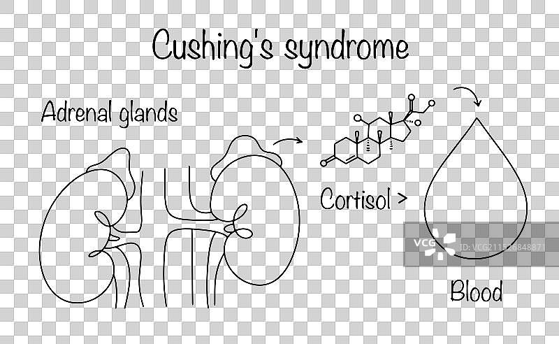库欣综合征图片素材
