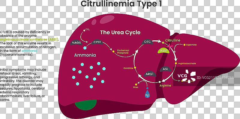 瓜氨酸血症1型ASS1缺乏症图片素材