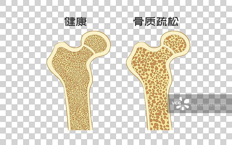 医疗健康骨质疏松科普插画图片素材