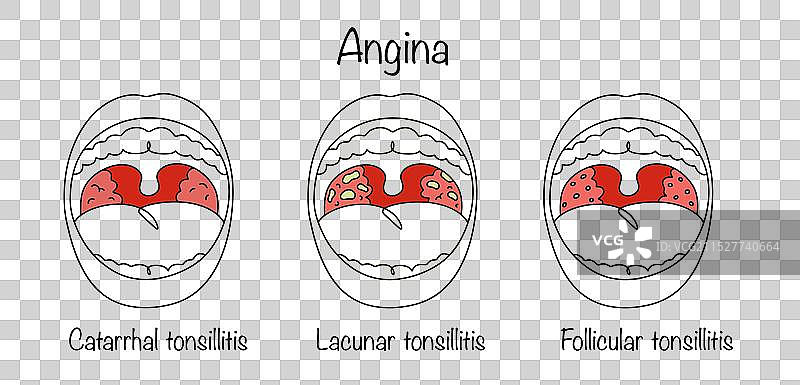 心绞痛图片素材