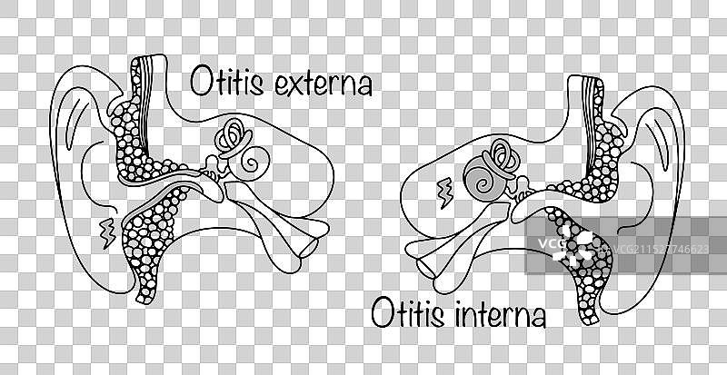 外耳炎 内耳炎图片素材