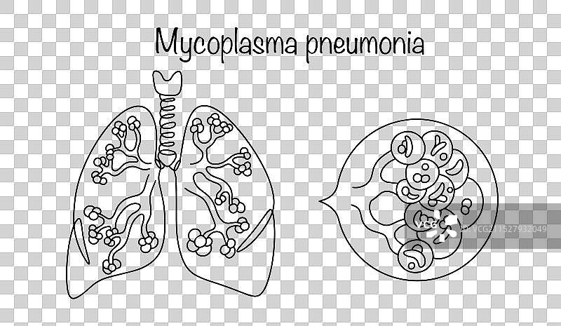 支原体肺炎图片素材