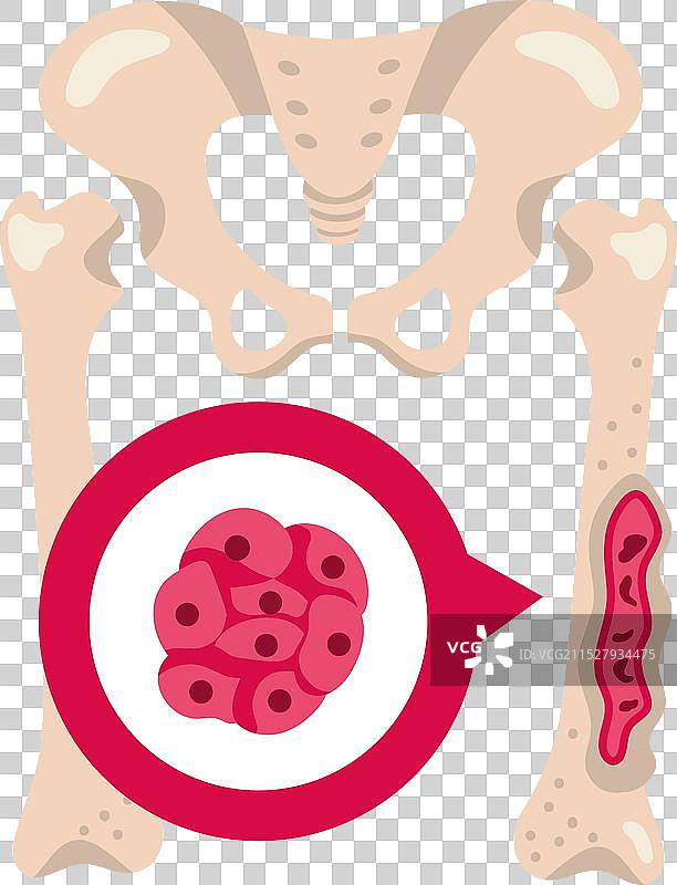 多发性骨髓瘤是一种骨髓癌。图片素材