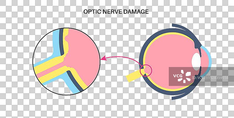 受损的视神经杯图片素材