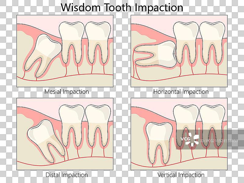 智齿阻生类型图解 医学图片素材
