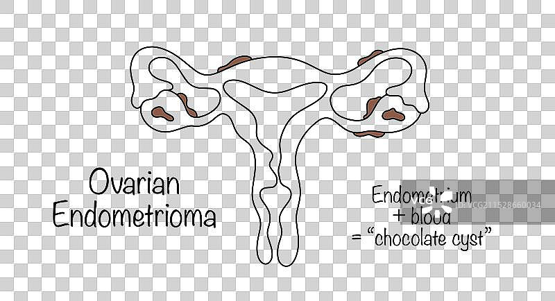 卵巢子宫内膜囊肿图片素材