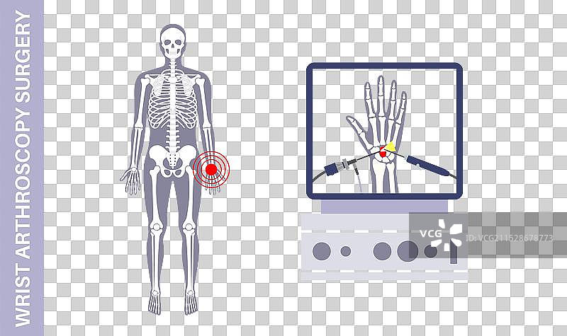 wrist arthroscopy surgery图片素材