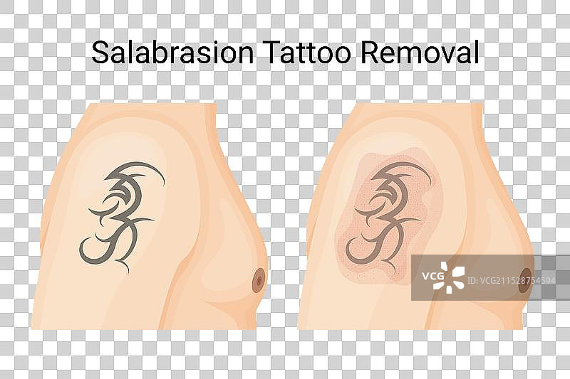 传统的非激光盐磨纹身去除图片素材