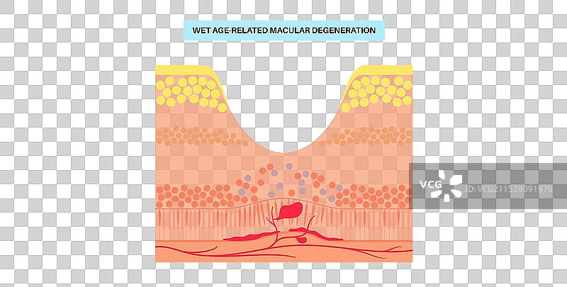 黄斑变性海报图片素材