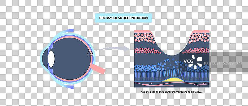 黄斑变性海报图片素材