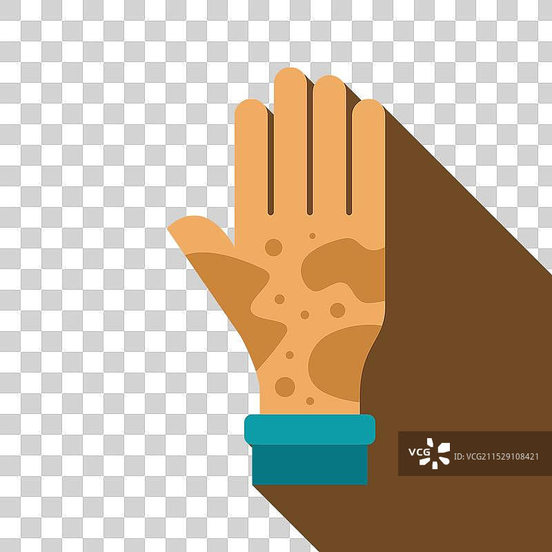 手部特写，显示白癜风症状图片素材