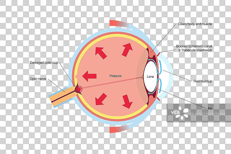 青光眼眼压图片素材