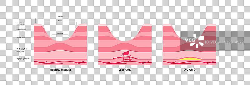 黄斑变性海报图片素材