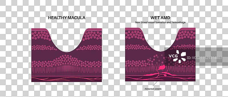 黄斑变性海报图片素材