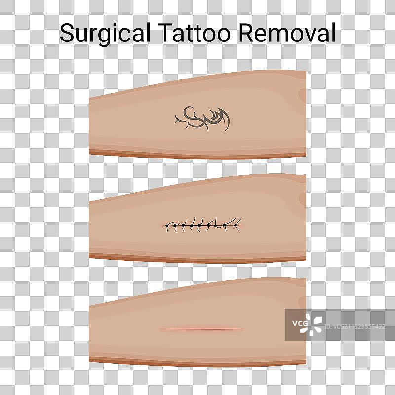 手术纹身去除过程的步骤图片素材