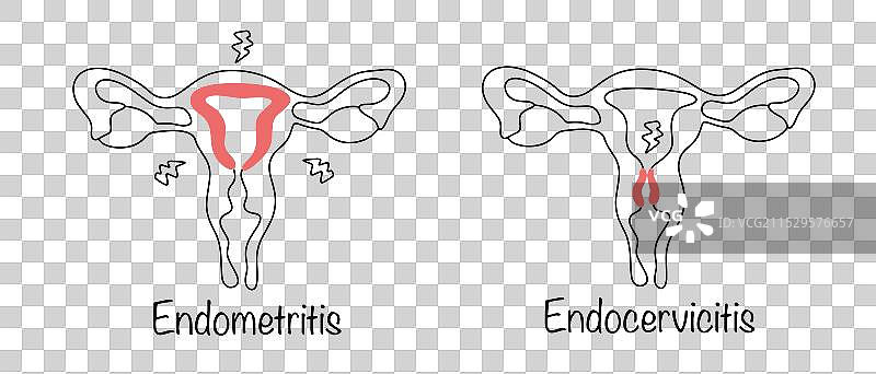 子宫内膜炎 子宫颈炎图片素材