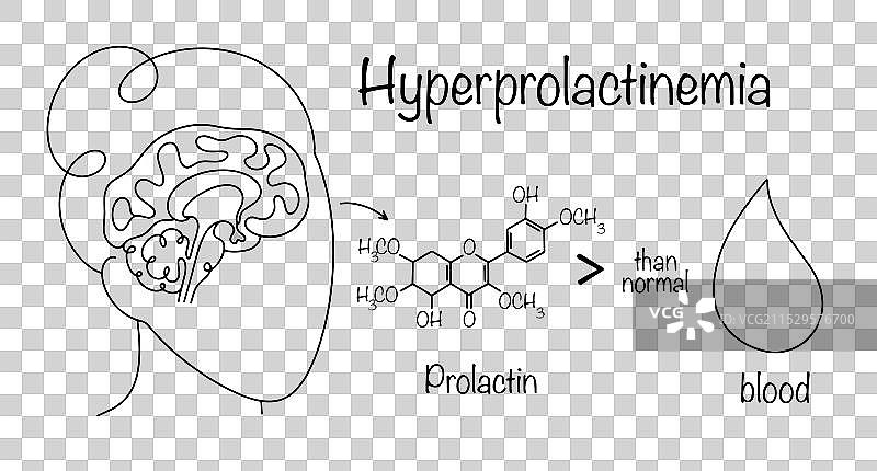 高泌乳素血症图片素材