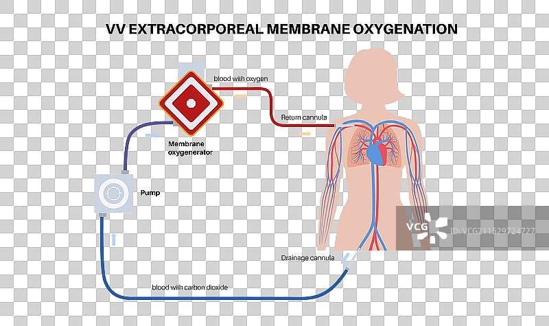 体外膜氧合图片素材