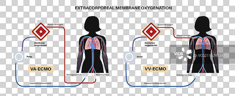 体外膜氧合图片素材