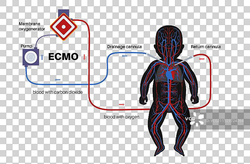 体外膜氧合图片素材